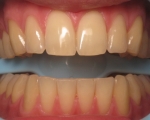 normal gums