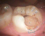 lower second molar severely decayed 