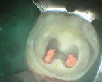 same tooth after removing decay and root canal treatment 
