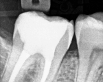 x-ray of the same tooth with the root canal treatment finished and the final restoration