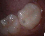 same tooth final restoration