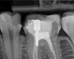 lower 1st molar unsuccessfully treated