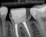x-ray of the re-treatment
