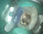 same tooth, repeating root canal treatment