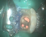 same tooth with the root canal re-treatment finished 