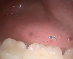 same tooth, final restoration with ceram onlay