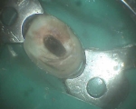 same tooth before built-up with a root post