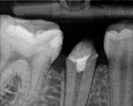 lower second premolar before prosthetic restoration with a root post 