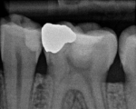 severe bone infection from lower first molar