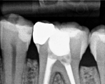 bone healing three months after root canal treatment