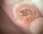 upper first molar with four roots sealed