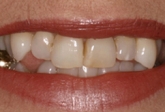 Porcelain Veneers