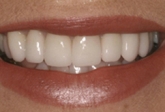 Porcelain Veneers