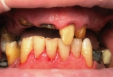Αντικατάσταση πολλών ελλειπόντων δοντιών