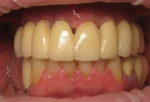 Multiple Teeth Replacement