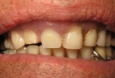 partial dentures with no stability and compromising chewing, speech and aesthetics. 
