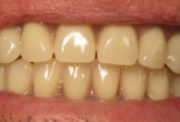 full dentures stabilized on implants with locator abutments