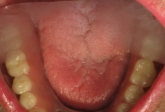 lower denture stabilized on four implants