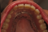 upper denture stabilized on four implants